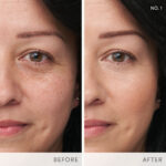 IC EnlightenPlus Before After NO1 Claudia